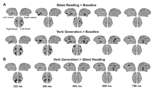 Figure 1. The brain response to the written nouns in verb generation (VG) and silent reading (SR) tasks: sensor-level analysis. (A) Three projections (SPM glass image) show the sensor array from above (transverse), the right (sagittal), and the back (coronal). A — anterior, P — posterior, L-left and R-right parts of the array. Pavlova A. A., Butorina A. V., Nikolaeva A. Y., Prokofyev A. O., Ulanov M. A., Stroganova T. A.(2017). Psychology in Russia: State of the Art, 10 (3), 190-205