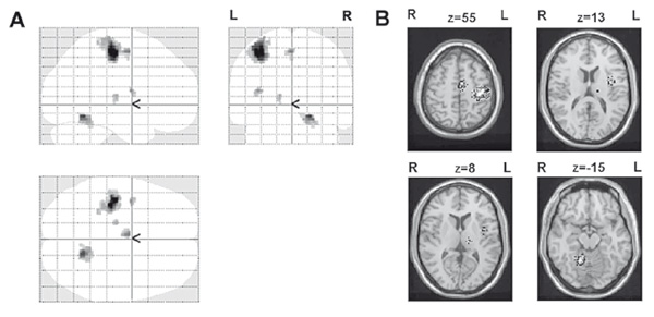 Figure 1. Brain areas activated during stimulus-driven movement. A –statistical parametric maps of activated areas, B –activated areas imposed on averaged brain. Sedov A. S., Popov V.A., Filyushkina V.I., Semenova U.N., Orlov V.A., Velichkovsky B. M., Ushakov V. L.(2017). Psychology in Russia: State of the Art, 10 (3), 206-217