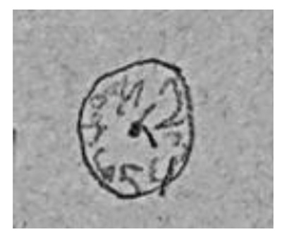 Figure 5. Free drawing of a “round” watch. Solovieva Yu., Rojas L.Q. (2017). Syndromic analysis in child neuropsychology: A case study. Psychology in Russia: State of the Art, 10 (4), 172-184