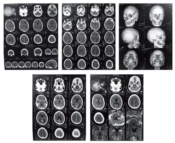Figure 1. CT scan 3 months after the accident. Solovieva Yu., Quintanar L. (2018). Luria’s syndrome analysis for neuropsychologicalassessment and rehabilitation. Psychology in Russia: State of the Art, 11 (2), 81-99. 