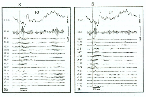 Figure 1. The wide and narrow band frequency filtering of ERP at F3 and F4 electrodes in the range of gamma activity between 30 and 45 Hz. The wide frequency filtering is under ERP. Below - the same ERP after narrow band filtering with the step in 1 Hz between 30 and 45 Hz