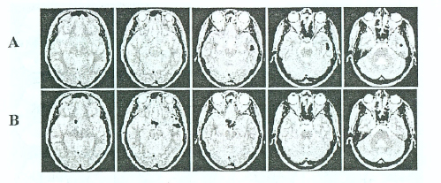 Figure 3. The projections of equivalent dipole sources are shown over axial slices received by structural MRI during sensory response (0-100 ms after stimulus onset) for a single subject. Dipole sources for gamma generator oscillating at 35 Hz during passive attention are found in a local zone in the auditory specific area of right temporal lobe. This activity zone is vertically oriented. Dipole sources of the gamma generators working at the same frequency during the reaction task performance are obtained in two local zones: in the modal specific cortex as well as in the medial prefrontal cortex.