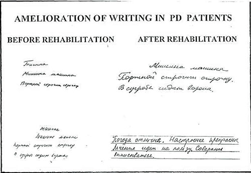 Rehabilitation of micrographia in patients with Parkinson’s disease